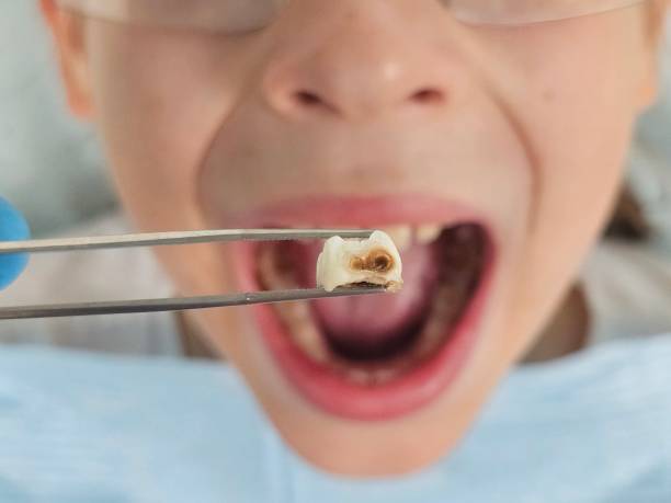 Best Emergency Tooth Extraction in Angustura, NM
